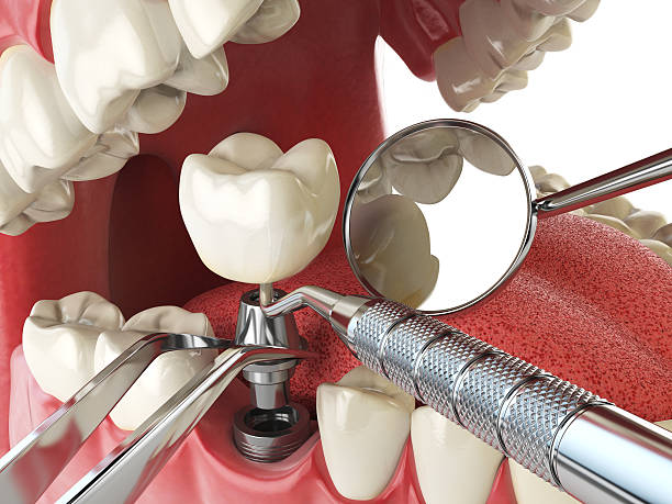 Best Broken or Cracked Tooth Emergency Dentist in Maysville, GA